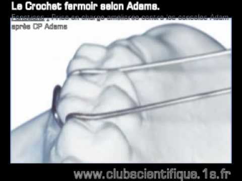 Le crochet adams, ces fonctions et ces variations en orthodontie.